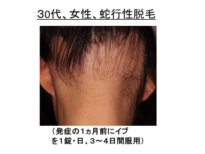 円形脱毛症　病院""